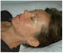 Best Face Lift Acupuncture in Glendale / Beverly Hills