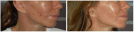 Best Face Lift Acupuncture in Glendale / Beverly Hills